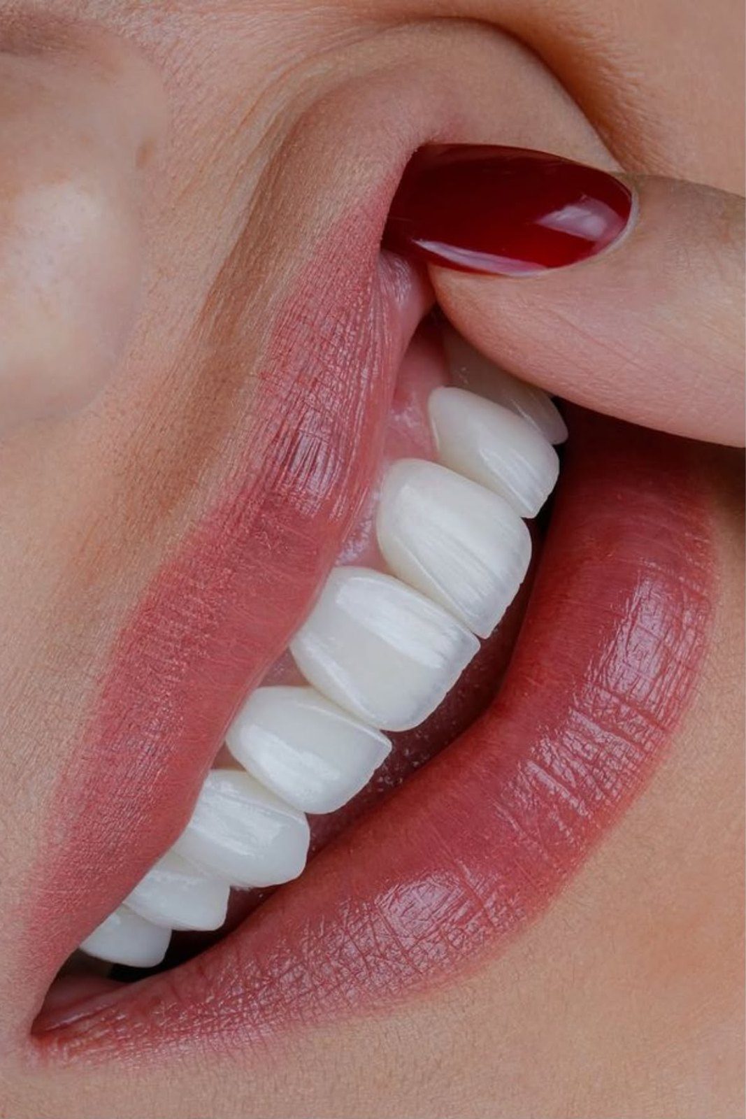 Detalle de una sonrisa con carillas